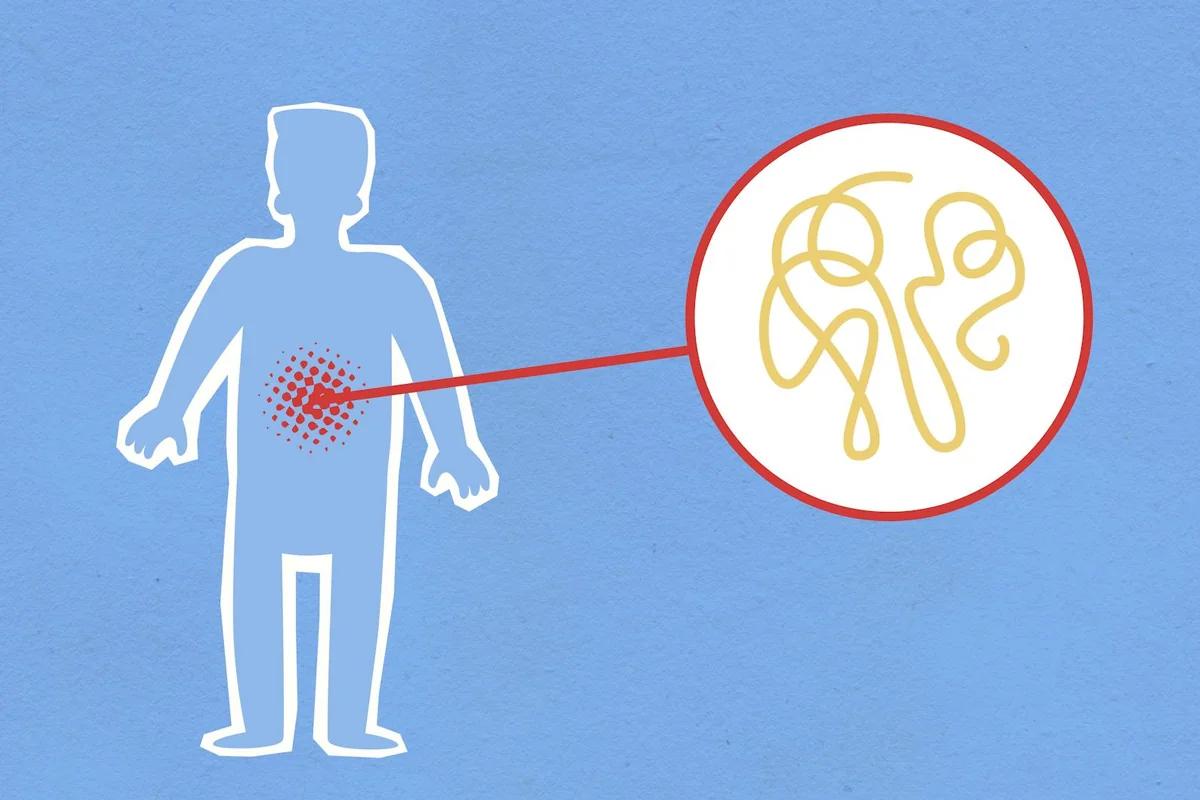 減肥藥Ozempic驚人副作用！胃裡長出「毛球」？醫生推黑可樂解塞